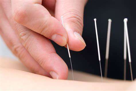 Acupuncture:ANeedle'sPathtoPainRelief