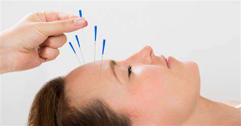 AcupunctureTreatmentforMigraineFrequencyandSeverity