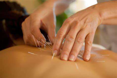 Acupuncture for Pain Relief: A Holistic Approach