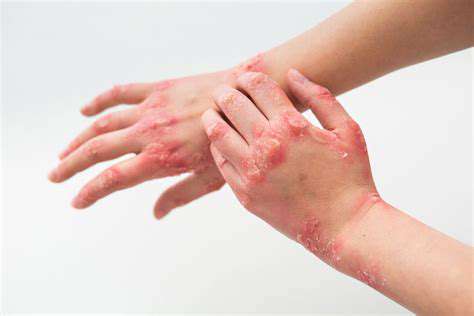 TCMDiagnosisandTreatmentforEczema