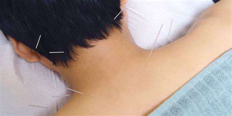 Acupuncture:AKeyTCMToolforPainRelief